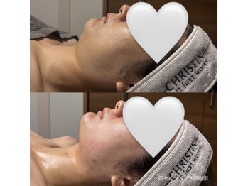 エクラ(eclat)の写真/あご下肉、即リセット。独自のスライドカッピング法だからこそだせる結果◎むくみ一掃、小顔形成が得意！