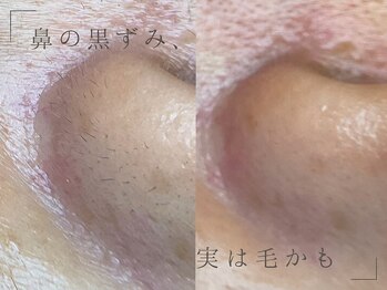 グリッター 泉中央店(GLITTER)の写真/《フェイシャルWax脱毛》頑固な毛穴詰まりもスッキリ解消。触れたくなるようなツルスベ肌へ導きます!
