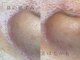 グリッター 泉中央店(GLITTER)の写真/《フェイシャルWax脱毛》頑固な毛穴詰まりもスッキリ解消。触れたくなるようなツルスベ肌へ導きます!