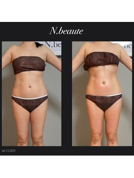 エヌボーテ(N. beaute)/before→ after全身コース一回目