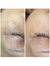 シーカラー 中野栄店(C.color)/シミケア◎50代女性