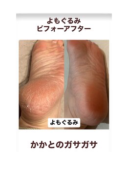 よもぐるみ 桃山台店/ビフォーアフター[よもぎ蒸し]