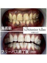 ホワイトニングサロン 京都烏丸店/ホワイトニング施術例