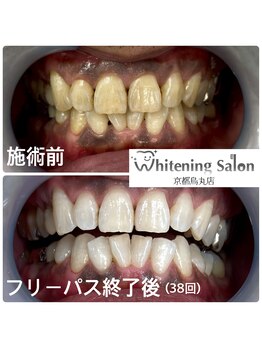 ホワイトニングサロン 京都烏丸店/ホワイトニング施術例
