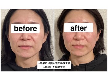 グリーン鍼灸整体院(green鍼灸整体院)/美容鍼(ビフォーアフター)
