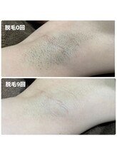 エリーザベル(Elisa Bell)/ワキ脱毛途中経過