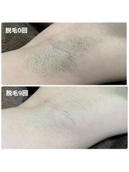 エリーザベル(Elisa Bell)/ワキ脱毛途中経過