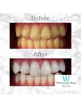 ホワイトニングショップ 秋田店/【大事なイベント前に是非♪】