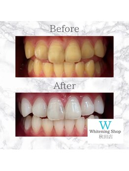 ホワイトニングショップ 秋田店/【大事なイベント前に是非♪】