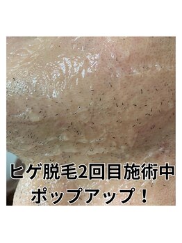 ミライキング(mirai king)/ヒゲ脱毛２回目ポップアップ