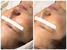 ベルドア(Bell Door)/ビタミンA導入トリートメント