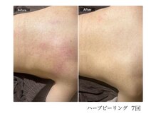 エミルカ 宮崎店(EMILUCA)/【クーポン有】背中症例