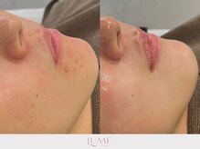 ルーミー 南青山(LUME)/ハーブピーリング／ニキビケア