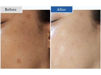 クラウドナインエステティック(Cloud Nine esthetic)の写真/コンシーラーいらずの肌へ♪光フェイシャル+ダクトピールで肌育成スイッチをオン☆水光ジェットでハリ艶+