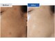 クラウドナインエステティック(Cloud Nine esthetic)の写真/コンシーラーいらずの肌へ♪光フェイシャル+ダクトピールで肌育成スイッチをオン☆水光ジェットでハリ艶+