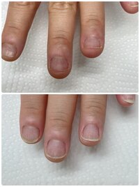 爪噛み1ヶ月経過　クリアジェル