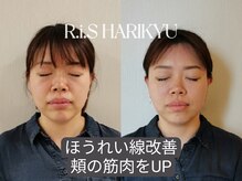 リス(R.i.S)/小顔矯正Before&After