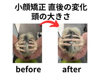 ほねつぎ 平成けやき通り鍼灸接骨院/小顔矯正で頭が小さくなりました