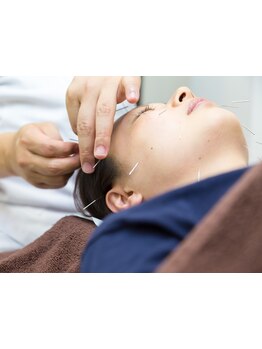 鍼灸施術を受けたい