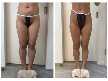 エイシスグロウ(asis glow.)/効果写真