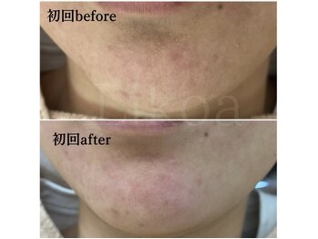 リコア(Likoa)/before after