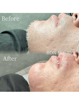 サロンロン 横浜関内(SALON RON)/白髪ヒゲ脱毛/美容電気脱毛