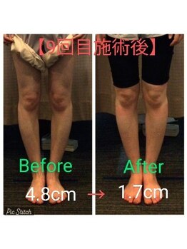 クシロ鍼灸整骨院/【O脚矯正】施術例