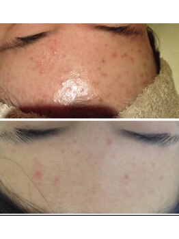 レヴィア(REVIA)/レディースフォトセラピー