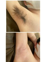 サロンドシェリ(salon de cheri)/Wax脱毛