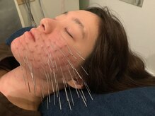 上野毛駅前整骨院 鍼灸院/美容鍼