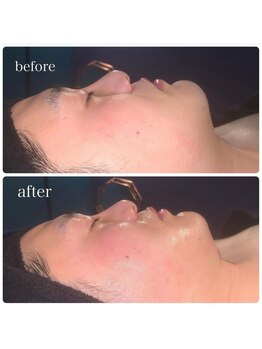 ベルフルール 西18丁目店/メンズ 韓国コルギ