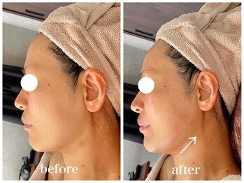 ルー ハナレ 神戸岡本 摂津本山店(Luu HANARE)/フェイスラインリフトアップ