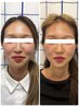 【フェイスライン、エラ張り、ハチ張り】でお悩みの方。小顔矯正!9900→