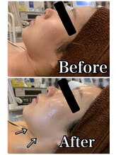 ブランシュール/炭酸カーボキシー×小顔タイト