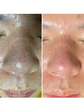 クイーン 熱海店(Queen)/男性の毛穴の開き・オイリー肌