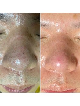 クイーン 熱海店(Queen)/男性の毛穴の開き・オイリー肌