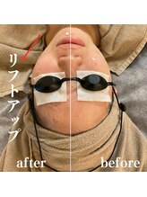 モンレーヴ(MonReve)/光フェイシャル