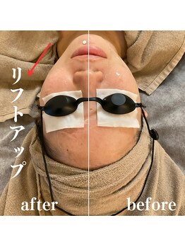 モンレーヴ(MonReve)/光フェイシャル