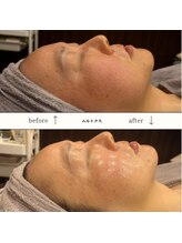 ビーエヌ エステティックアンドスパ(BN Esthetic&Spa)/40代ムルトクスピーリング