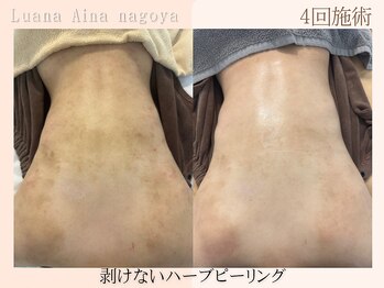 ノイエ(NOIE)/背中ハーブピーリング