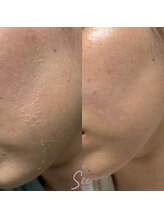 ジュエッテ(jouete)/シーナジーピール