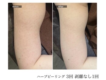 エミルカ 宮崎店(EMILUCA)/【クーポン有】二の腕症例