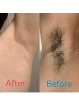 サロン ルポ 高槻(Salon Repo)/【ダブル脱毛】ワキ