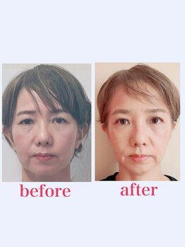 ブロッサム 山内店/フェイスリリース★効果写真