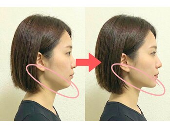 ニュートラル 渋谷店(NEUTRAL)/フェイスライン変化【小顔矯正】