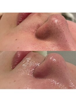 ミューズ(MUSE)/毛穴エクストラクション＋顔脱毛