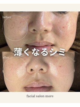 ヨサ モア(yosa more)/【40代シミ】BeforeAfter