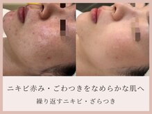 サロン ド ボーテ シャルル(Chaleureux)の雰囲気（ニキビ・赤み・ごわつき）