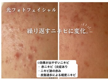 フジモトサロン 那覇おもろまち店(fujimotoサロン)/那覇/繰り返すニキビ肌質改善