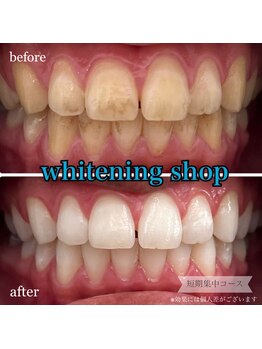 ホワイトニングショップ 桜木町店/【飲食からのステイン着色】